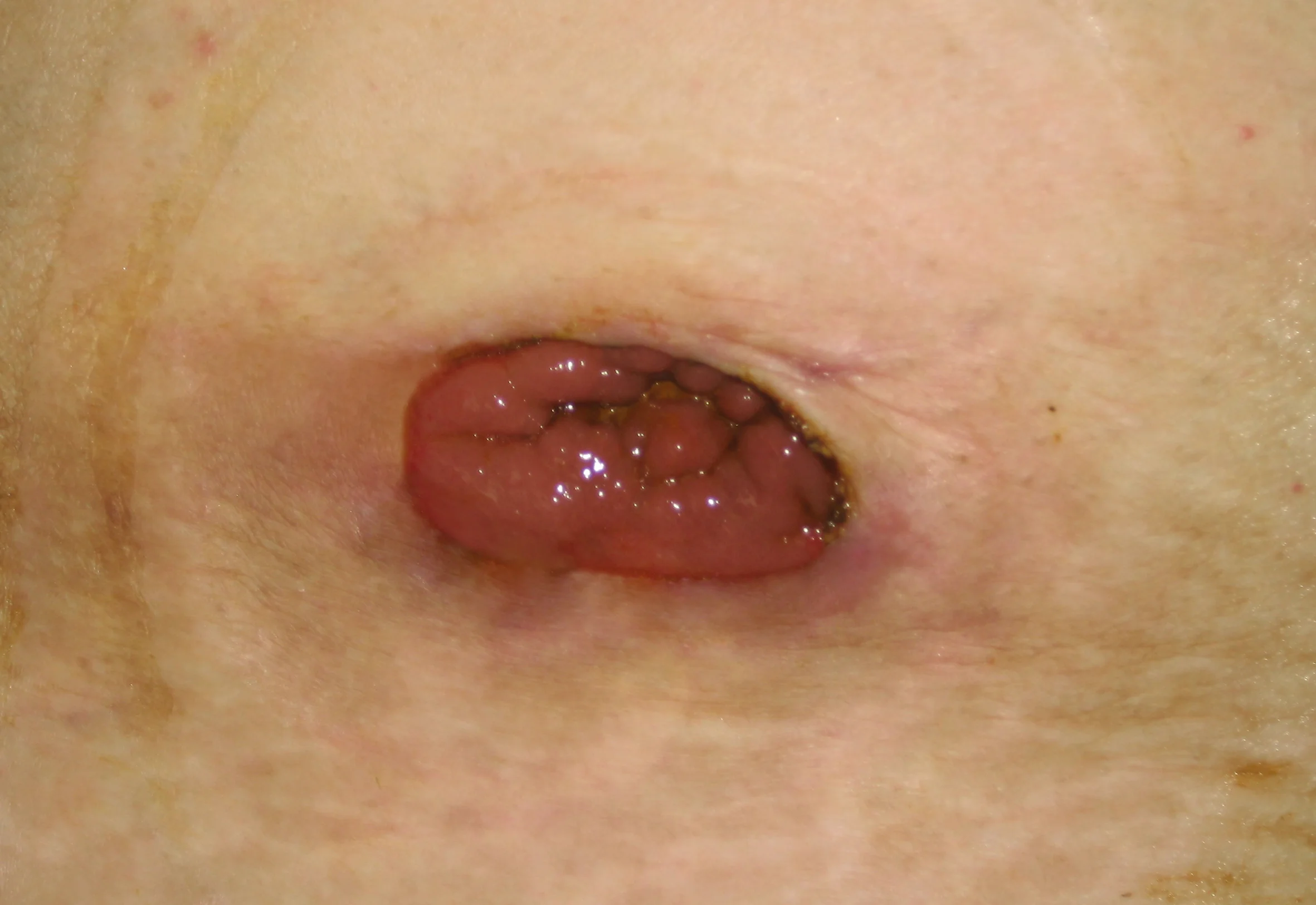 Flush Stoma no border - Ostomy Basics